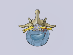lumbar disc tear