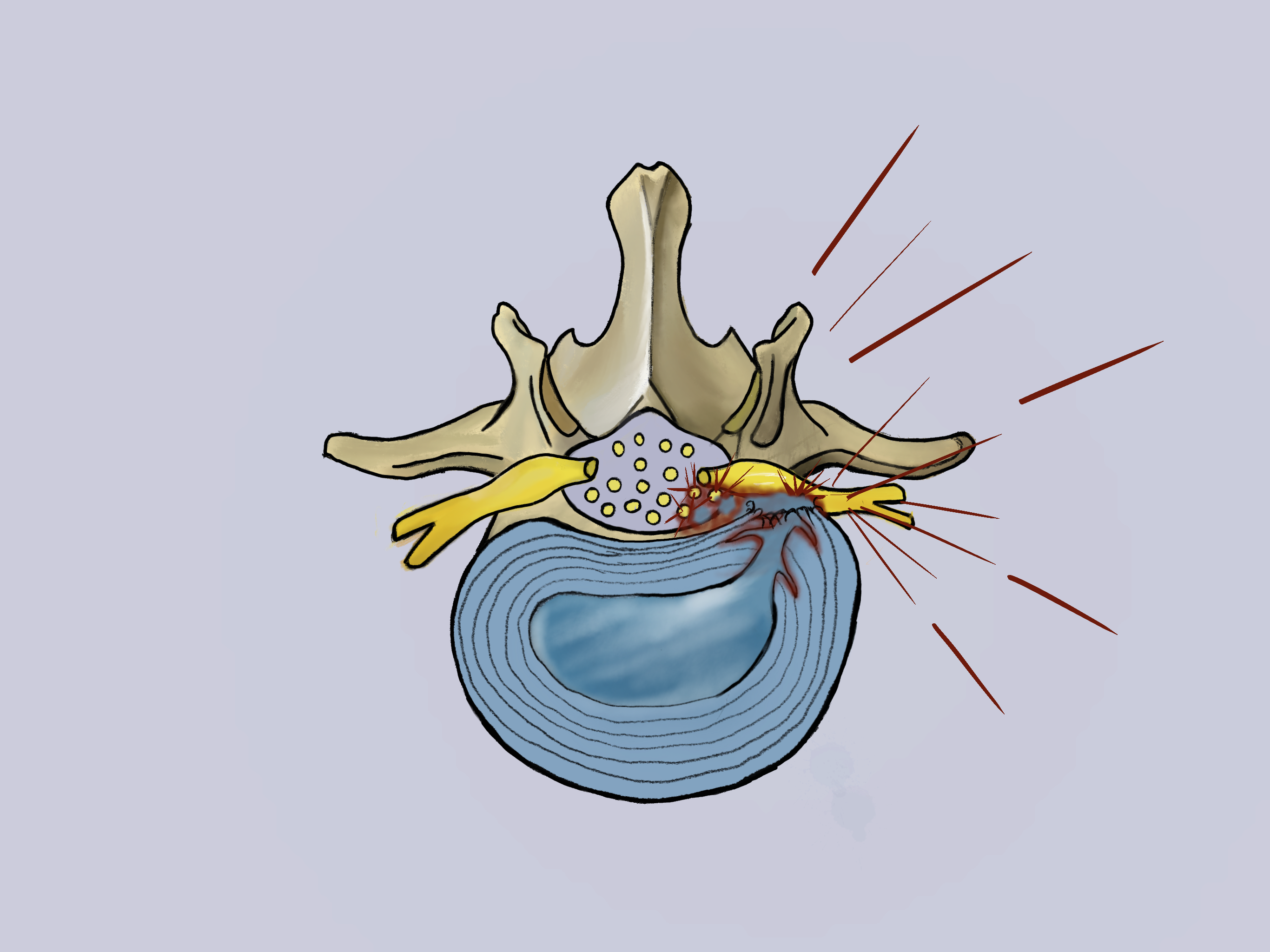 Disc sequestration