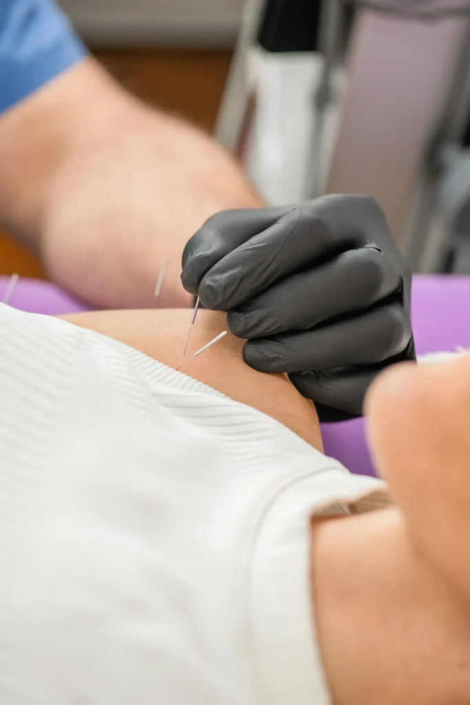 acupuncture treatment with glove 2026 03 25 03 13 28 utc