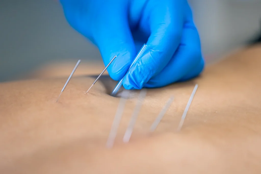 close up of a needle and hands of physiotherapist 2026 03 24 04 05 07 utc